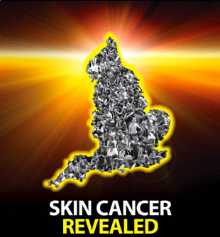 Skin Cancer Revealed